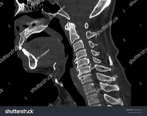Computer Tomography Ct Scan Cervical Spine Stock Photo 1585665967