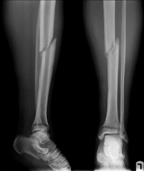 Types Of Tibia Fractures