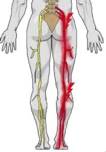 Muscles in the low back, abdomen, buttocks, and hips are all necessary for supporting and stabilizing the spine. Could You be Suffering from Sciatica? - Cawley Physical ...