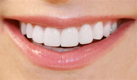 Different Types Of Dental Veneers For A Perfect Smile