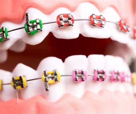 8 Signs Your Child Needs Braces