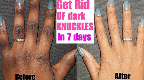 How To Get Rid Of Dark Knuckles Fast Youtube