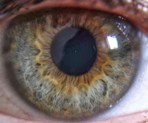 I Have Central Heterochromia Which Gives Me An Extra Color Around My