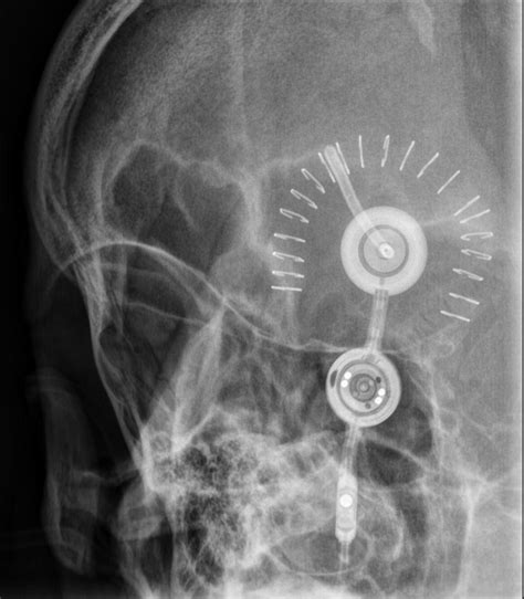 Programmable Shunt A Lateral Radiograph Of The Skull Shows A Sexiz Pix