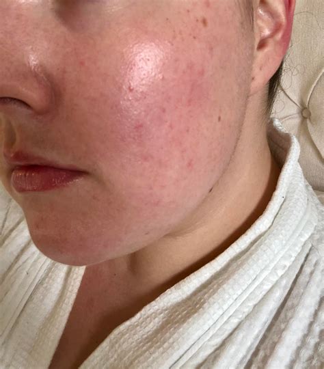 Skin Concerns Tiny Red Bumps On My Cheeks Could I Be Over