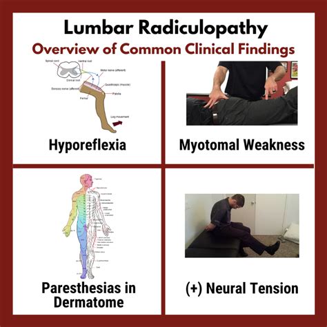 Lumbar Radiculopathy Treatment Causes Symptoms Risk Factors Sexiz Pix