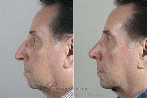 Chin Augmentation For Men New Jersey Parker Center For Plastic Surgery