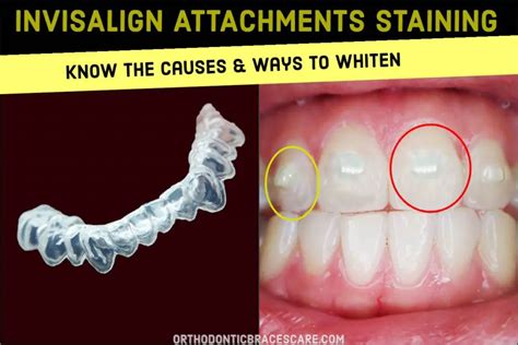 Invisalign Attachments Staining How To Whiten And Clean Orthodontic