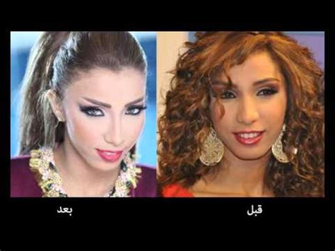 أو بالأحرى هوس تنحيف الأنف السائد بين السيدات في المنطقة العربية على وجه الخصوص وذلك تشبها بالأوروبيات سلبيات عمليات التجميل. دنيا بطمة قبل و بعد عمليات التجميل 2019 - YouTube