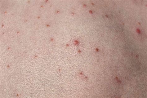 Bacterial Skin Rash 9 Common Infections