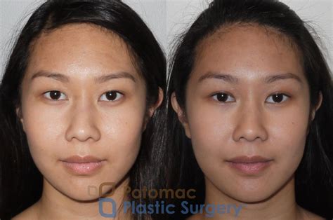 Asian Eyelid Surgery Before And After Photo Gallery Washington Dc