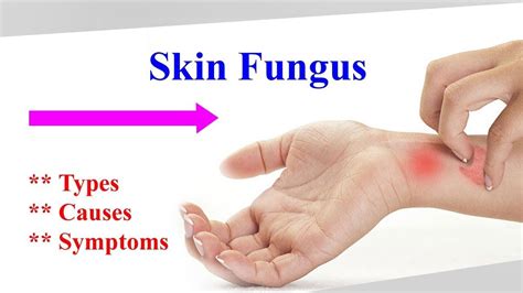 Skin Fungus Top Causes Of Fungal Infection And Fungal Diseases
