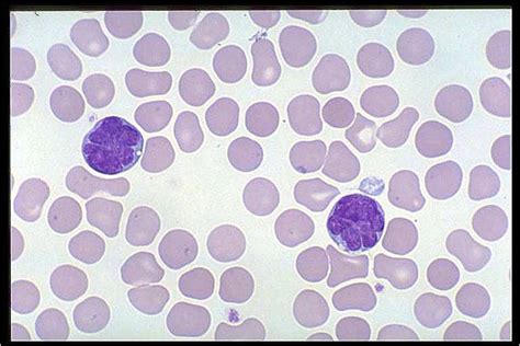 Acute T Cell Leukemia Lymphoma Meddic