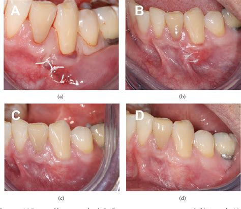 Figure From Gingival Cyst Of The Adult As Early Sequela Of Connective