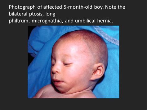 P Mosaic Deletion Duplication Syndrome Gbpikol