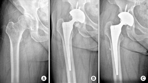 Anteroposterior Radiographs Showing The Right Hip Of A 51 Year Old