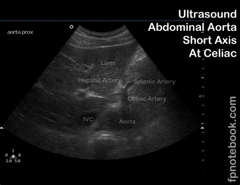 Abdominal Aorta Mid Transverse At Level Of Celiac Trunk Ultrasound