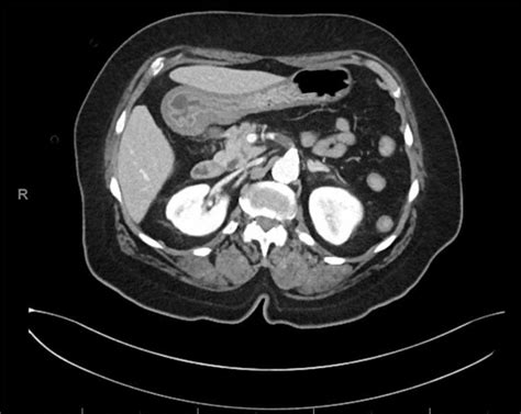 Ct Abdomen And Pelvis With Iv Contrast Axial Image Of 17 Cm Occlusive