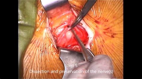 Inguinal Hernia Repair Step By Step Local Anesthesia Infiltration Made