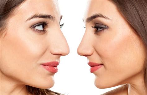 How To Nose Reshaping Surgery And Its Benefits