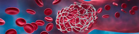 How To Prevent Blood Clots 6 Ways To Reduce Your Risk