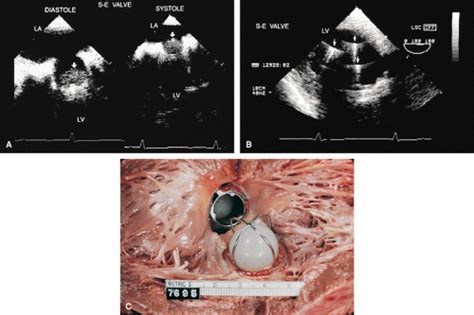 Prosthetic Valves And Rings Thoracic Key