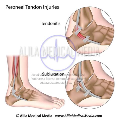 Alila Medical Media Peroneal Tendon Injury Diagram Medical Illustration