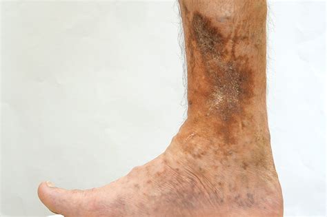 Patient Story About Venous Ulcers Advanced Vein Thera