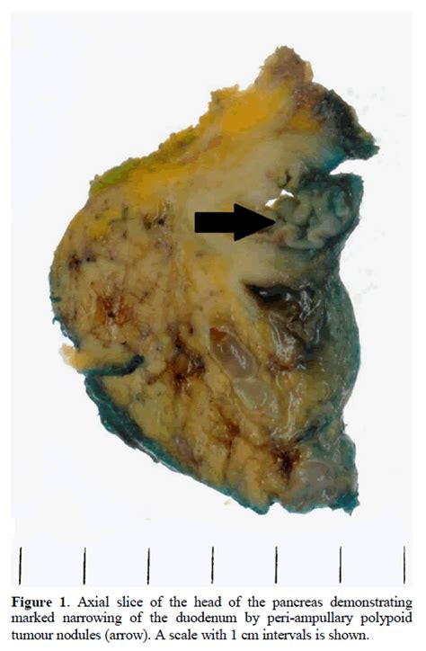 Poorly Differentiated Signet Ring Cell Carcinoma Of The Ampulla Of Vater Report Of A Rare