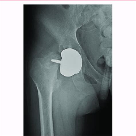Periprosthetic Fracture On Unsealed Prosthesis Of The Right Hip After A