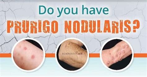 Do You Have Prurigo Nodularis You May Qualify For A New Clinical Trial