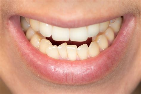 Help My Teeth Are Crowding With Age Sunnyside Dental