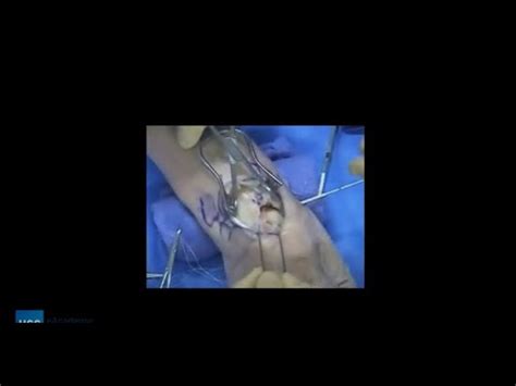 Scapholunate Ligament Repair Youtube