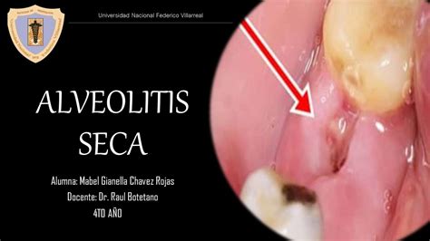 Semana 08 Alveolitis Seca Youtube