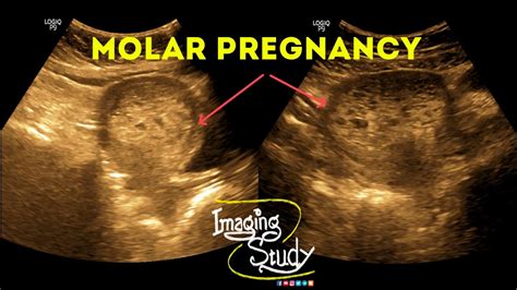 Molar Pregnancy Hydatidiform Mole Gestational Trophoblastic