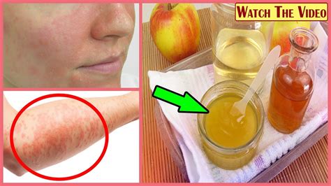 How To Cure Eczema With Apple Cider Vinegar Youtube