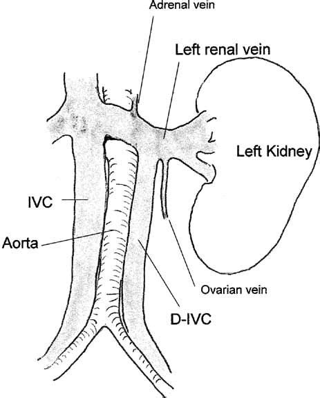 Duplicated Inferior Vena Cava—something To Consider In The Evaluation