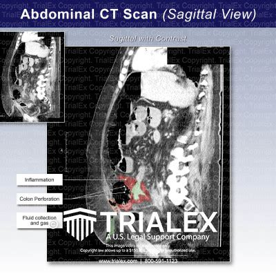 Ct Scan Of The Abdomen Sagittal View Trialexhibits Inc