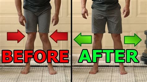 5 Ways To Fix Knocked Knees Tight Inner Thighs Youtube