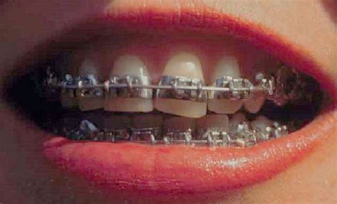 fully banded braces 1970s 1980s orthodontics in 2022 dental braces metal braces orthodontics