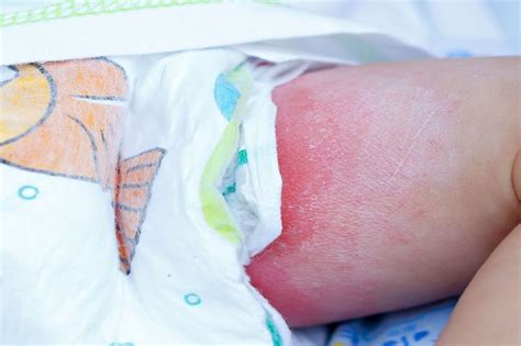 Can Infections Trigger Diaper Rash New Ternds