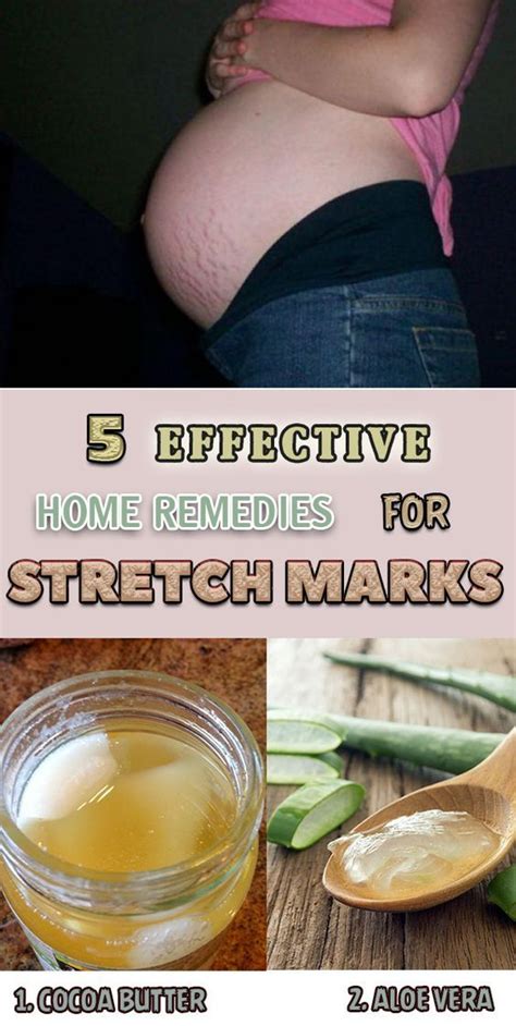 5 Home Remedies Against Stretch Marks Stretch Mark Remedies Stretch