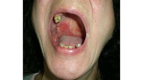 Oral Squamous Cell Carcinoma Mouth Cancer Symptoms And More