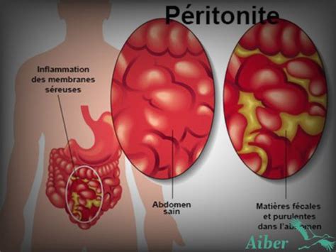 Peritonite la peritonite è un'infiammazione del peritoneo, le linee di tessuto che coprono la parete del ventre e gli organi addominali. Peritonite 【Guía Actualizada 2021