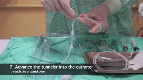 Tk Catheter Insertion For Peritoneal Dialysis By Nephrologist Youtube
