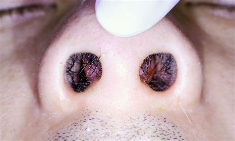 Nasal Septal Abscess Causes Symptoms Ddx Complications Sexiezpicz Web