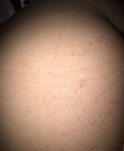 butt [acne] skincareaddiction