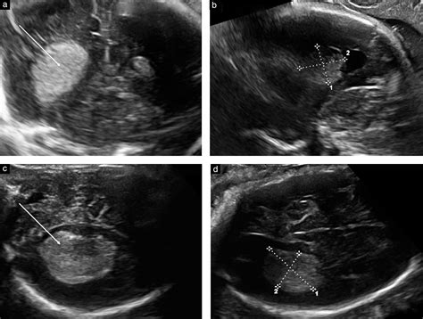 Fetal Tumors Of The Choroid Plexus Is Differential Diagnosis Between