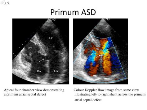 Ppt Echo Assessment Of Atrial Septal Defect Powerpoint Presentation