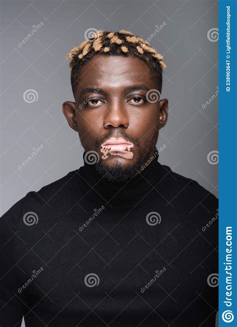 Young African American Man With Vitiligo Stock Image Image Of